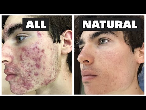 How I Cleared My Acne Without Accutane