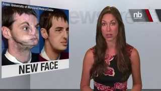 Breaking: Face Transplant Helps Disfigured Victim Of Gunshot Accident!