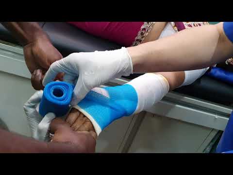 Plastering | Fiberglass | technique below elbow for a lower end Radius fracture | Adamya hospital vd