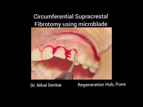 Micro Blade