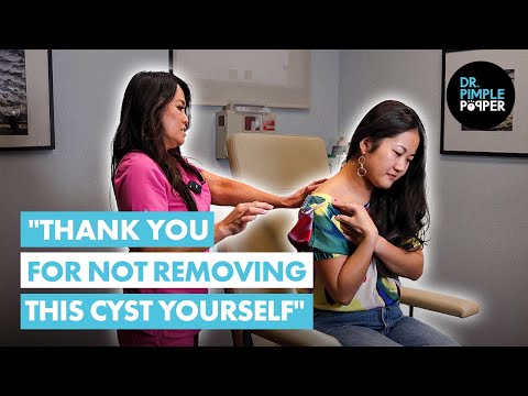 "Thank You for Not Removing this Cyst Yourself": Dr. Lee Meets J Before Her Cyst Procedure