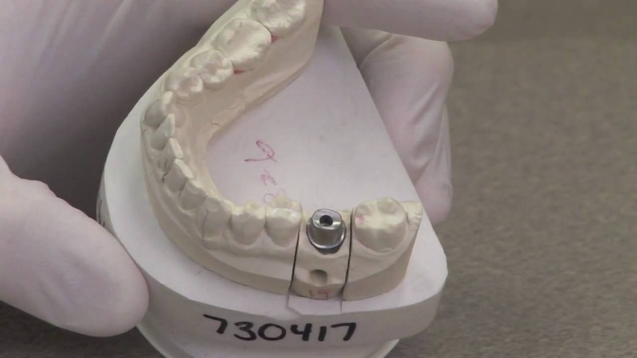 Dental Implants Explained