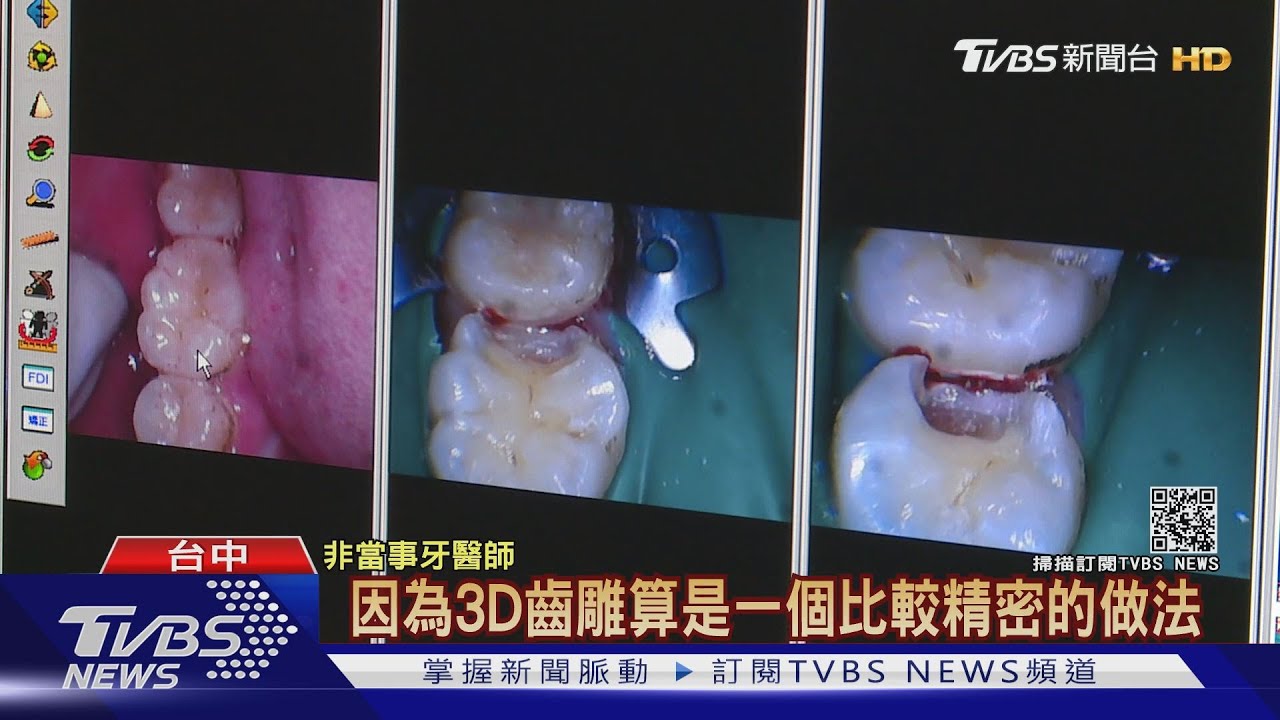 「3D齒雕」變「滿嘴膠」 女控牙醫治療有問題
