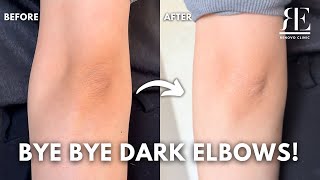 ✨ Say Goodbye to Dark Elbows! Brightening Treatment for Body Pigmentation