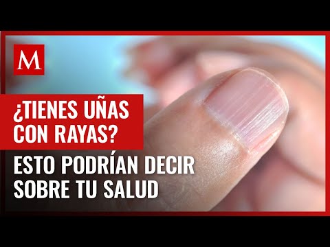 Nail stripes could be an indication of some medical conditions; we'll tell you which ones.