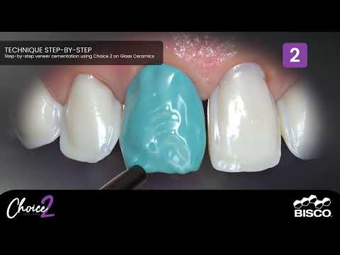 Choice 2 Veneer Cement Product Video