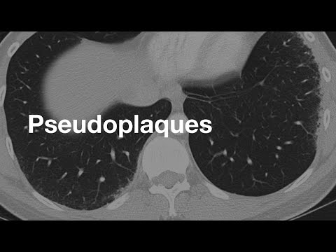 Pseudoplaques