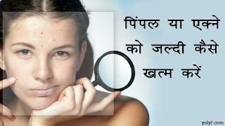 Know How to Get Rid of Pimples/Acne Fast in Hindi | पिंपल या एक्ने को जल्दी कैसे ख़त्म करें