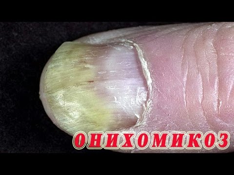 Was ist Candidose der Nägel, wie zu behandeln Der Anbruch auf dem Nagel gribok