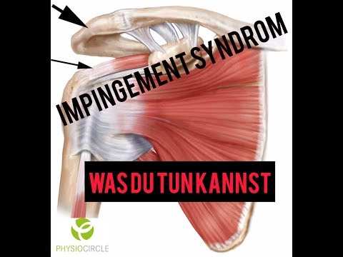 Impingement Syndrom Schulter