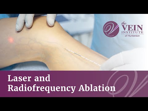 Laser and Radiofrequency Ablation