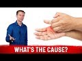 What Causes Sweaty / Dry Hands & How To Get Rid Of It? – Dr. Berg