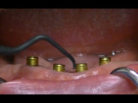 Cleaning & Maintaining LOCATOR Overdentures