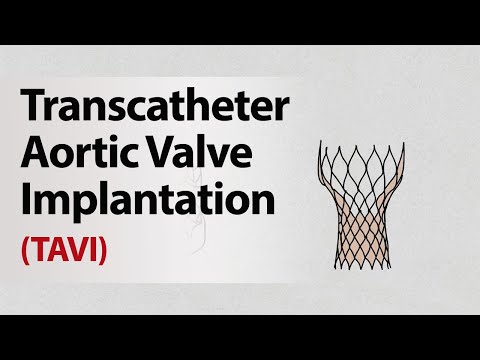 Transcatheter Aortic Valve Implantation TAVI