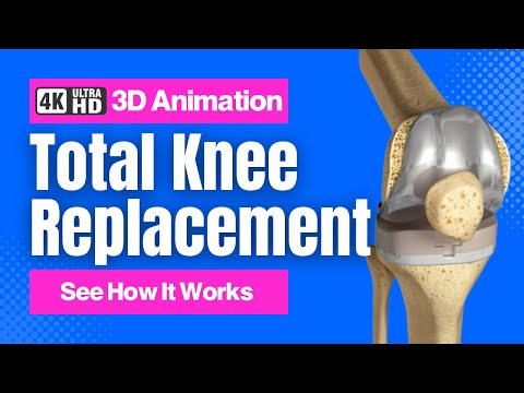 Total Knee Replacement - See How It Works