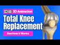 Total Knee Replacement See How It Works
