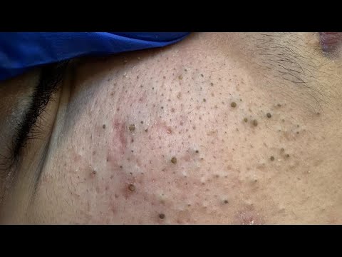 [ASMR] Deep Pore Cleaning and Whitehead Removal Therapy