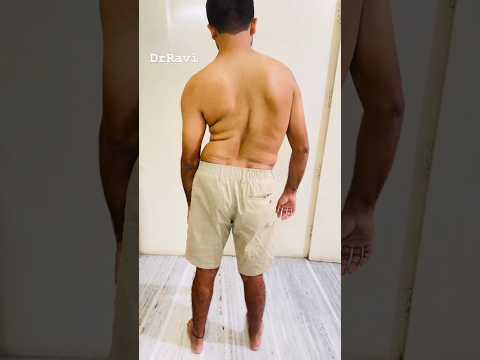 Scoliosis treatment #scoliosistreatment #scoliosisawareness #spine #chiropractic #physio #kyphosis