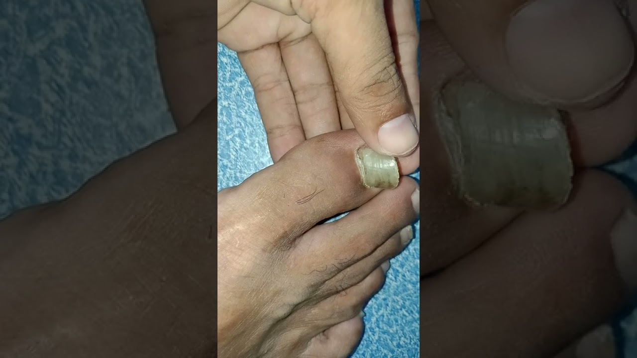 Putar video Patay na kuko sekarang Patay na kuko