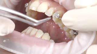 KHÍ CỤ CARRIERE MOTION ĐIỀU TRỊ SAI KHỚP CẮN LOẠI II VÀ III