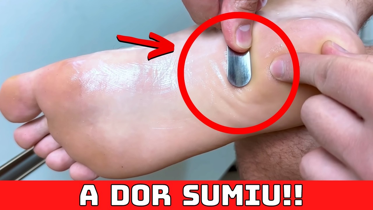 Plantar Fasciitis: Home Treatment That Truly Works