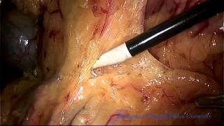 China: Laparoscopically Assisted Distal Gastrectomy for Early Gastric Cancer: How I Do It Series