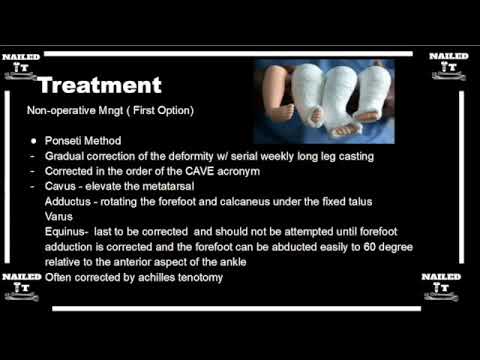 CASTING CLUBFOOT EXPLAINED! w/ Dr. Gantsoudes