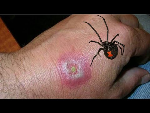Widow spider bite | symptoms, treatment | What does the bite site look like?