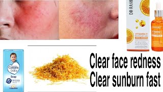 FACE REDNESS: CLEAR FACE REDNESS FAST WITH THIS WONDERFUL AFFORDABLE PRODUCT|CAUSES OF FACE REDNESS