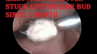 Removal of Forgotten Stuck Cotton Ear bud since 1 month from Ear Canal