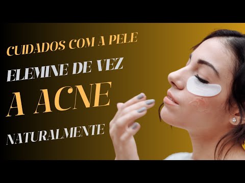 Como Me LIVREI da MINHA ACNE Naturalmente | a Única Coisa Funcionou