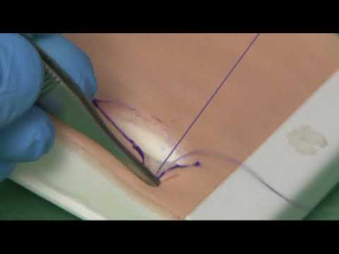 Medical Skills Deep Dermal Suture Technique