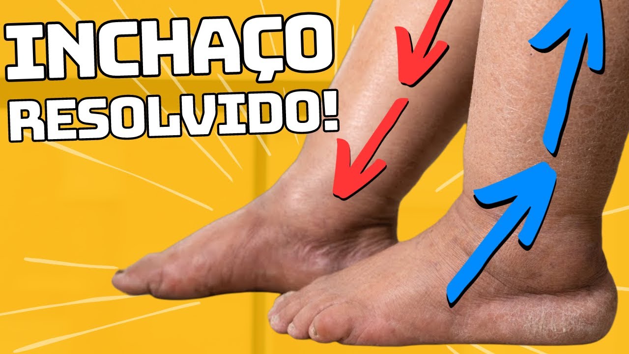 Como melhorar o INCHAÇO E MÁ CIRCULAÇÃO das pernas e pés (faça em casa)
