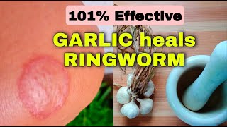 GARLIC Heals RINGWORM.  101% Effective.  Cure in as fast as 2 days.