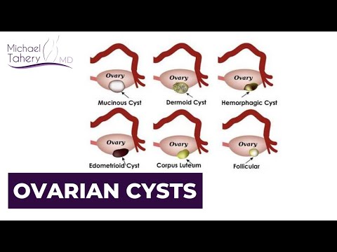 Types Of Ovarian Cysts | Los Angeles | Dr Michael Tahery