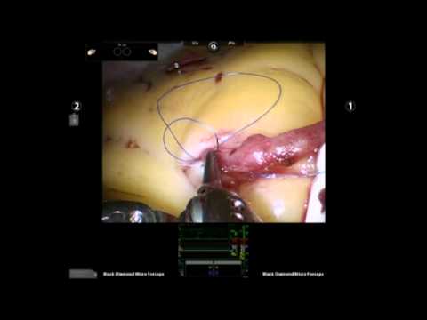 Totally Endoscopic Robotic Suturing Of A Coronary Bypass Anastomosis