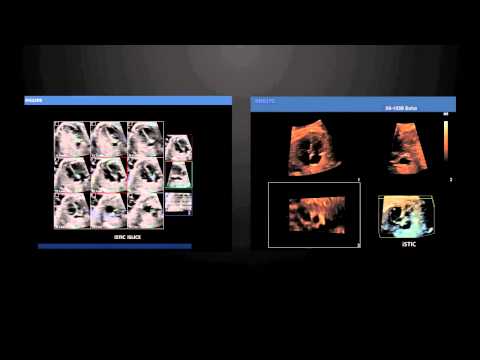 May Sieu Am Philips - iU22 (Q.Lộc: 0936.124561) WHC xMATRIX hd