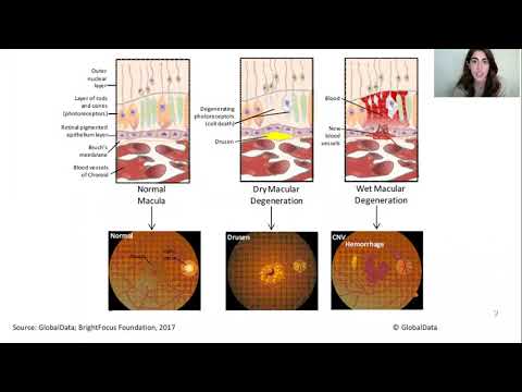 Gel cell delivery scaffolds for dAMD Presentation by Nicole Amaral- C2020 Innovation Hub AGM