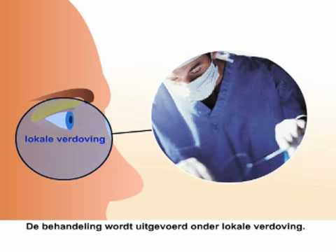 video Ooglidcorrectie thumbnail
