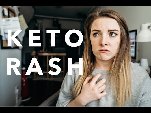 I CURED MY KETO RASH | My Experience With Keto Rash and How I Found Relief