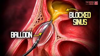 How this Tiny Balloon Opens Blocked Sinuses