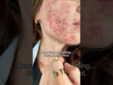 Changed My Skin Forever in 52 Days using Beef Tallow.