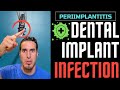 If you wear DENTAL IMPLANTS you should WATCH THIS - Dental Implant INFECTION or PERIIMPLANTITIS