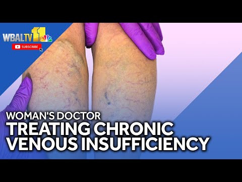 This is how to treat CVI