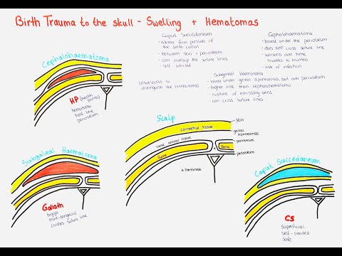 Caput Succedaneum, Cephalohematoma, Subgaleal Hemorrhage