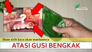 Download lagu Gusi Bengkak Kempes|Cara Mengatasi Gusi Bengkak Secara Cepat dan Efektif mp3 Download lagu Gusi Bengkak Kempes|Cara Mengatasi Gusi Bengkak Secara Cepat dan Efektif mp3