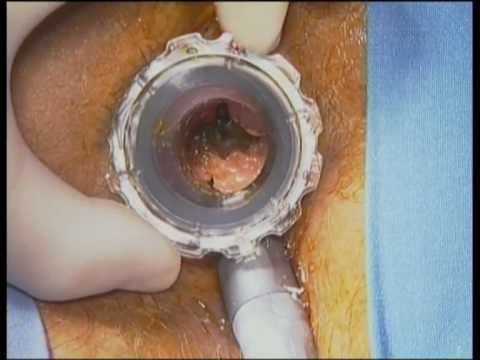 Massaggio prostatico con Vibro Il cancro alla prostata fino al 30