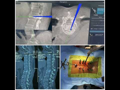 Neuro Navigation And arm :In and Minimal invasive spine surgery 