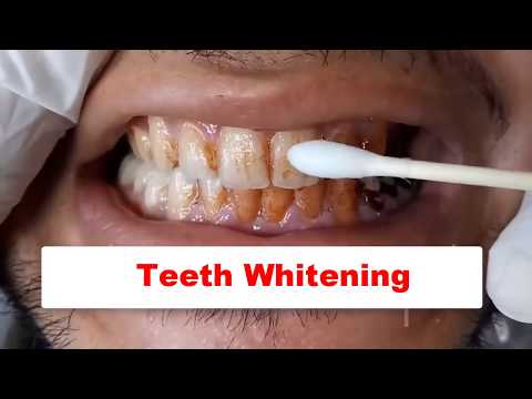 LABENA TEETH WHITENING ESSENSE