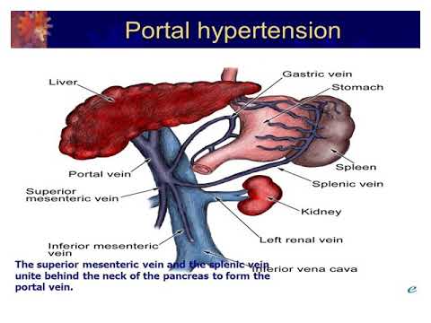 Portal Hypertension By Dr Ahmed Fawzey
